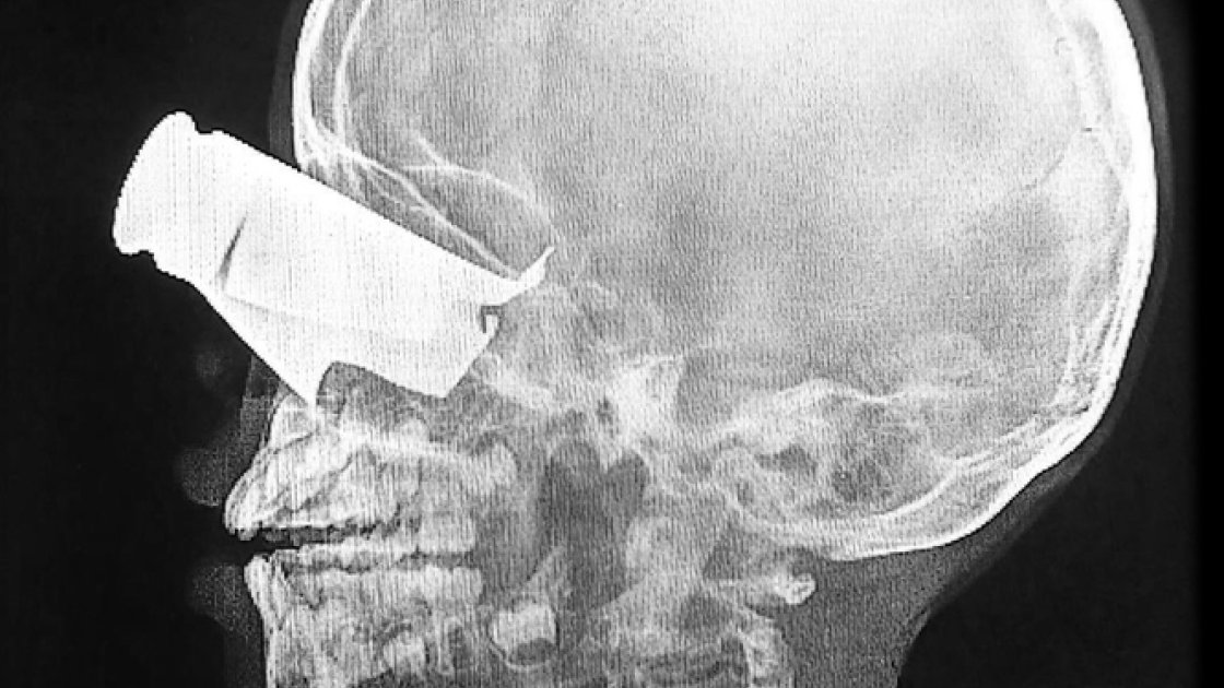 Un niño de 9 años llegó así al hospital apoyado por MSF en Tine, Chad, tras un ataque con drones en el oeste de Sudán en febrero de 2026. Presentaba una extensa herida de metralla en el ojo, fracturas faciales graves y dos dedos amputados. Fue trasladado a Yamena, la capital de Chad, para recibir tratamiento adicional.