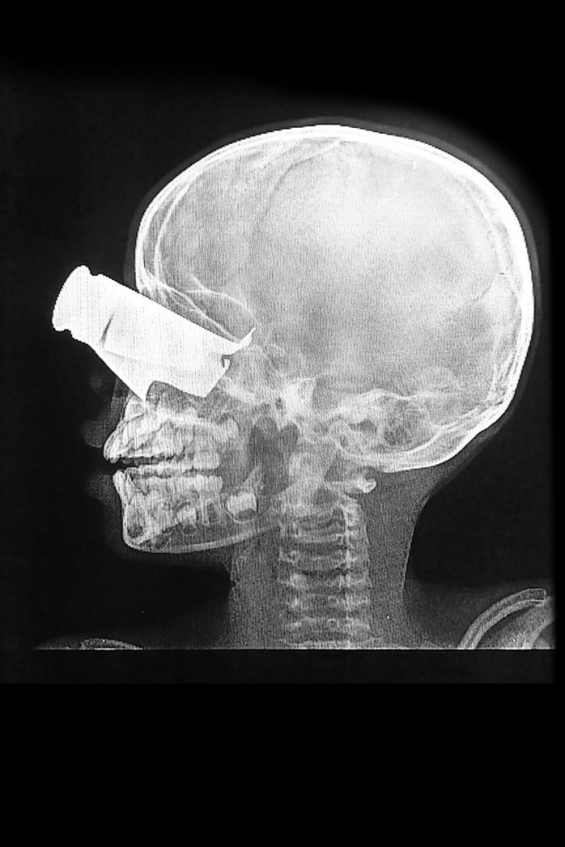 Un niño de 9 años llegó así al hospital apoyado por MSF en Tine, Chad, tras un ataque con drones en el oeste de Sudán en febrero de 2026. Presentaba una extensa herida de metralla en el ojo, fracturas faciales graves y dos dedos amputados. Fue trasladado a Yamena, la capital de Chad, para recibir tratamiento adicional. Un niño de 9 años llegó así al hospital apoyado por MSF en Tine, Chad, tras un ataque con drones en el oeste de Sudán en febrero de 2026. Presentaba una extensa herida de metralla en el ojo, fracturas faciales graves y dos dedos amputados. Fue trasladado a Yamena, la capital de Chad, para recibir tratamiento adicional.